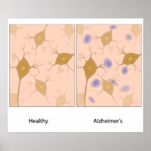 Alzheimer's disease brain tissue  Poster