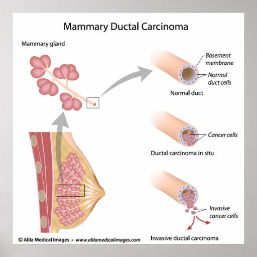 Breast Cancer Ductal Carcinoma   Labelled Diagram