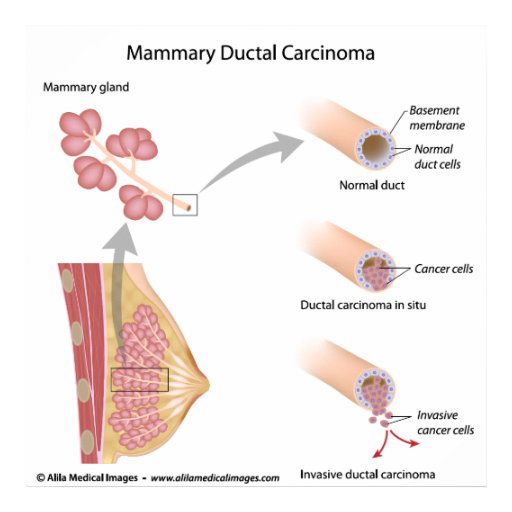 Breast Cancer Ductal Carcinoma   Labelled Diagram