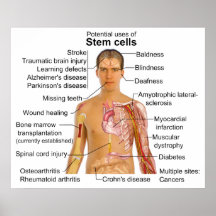 Chart of Potential Uses for Stem Cell Treatments Posters