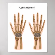 Colles fractures Poster