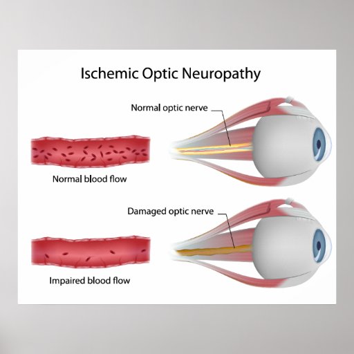 Ischemic Optic Ischemic Neuropathy