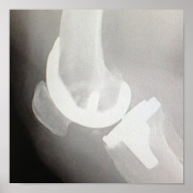 Knee Replacement - poster