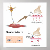 Myasthenia Gravis eye Poster