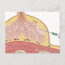 Search for needling postcards Medical