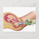 Search for childbirth postcards Amniotic sac