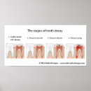 Search for caries Disease