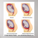 Search for childbirth Gynaecology