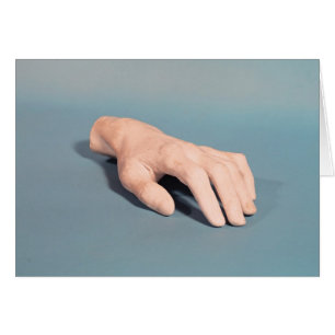 A cast of the hand of Frederic Chopin