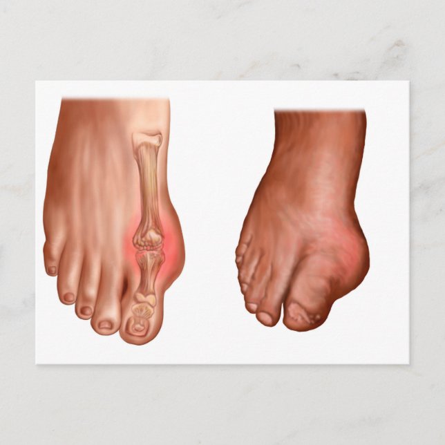 Anatomy Of A Swollen Foot Postcard (Front)