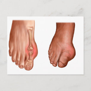 Anatomy Of A Swollen Foot Postcard