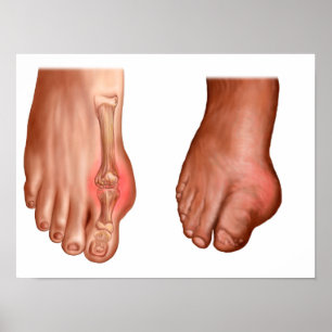 Anatomy Of A Swollen Foot Poster