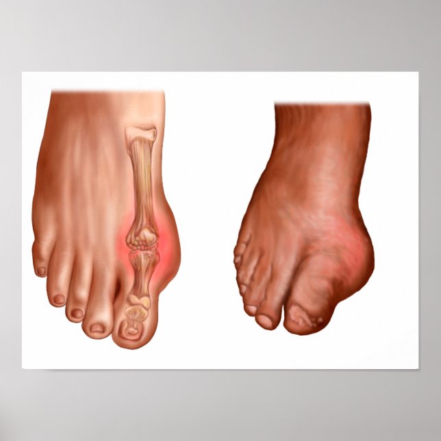 Anatomy Of A Swollen Foot Poster (Front)