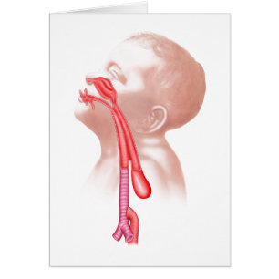 Anatomy Of A Tracheoesophageal Fistula