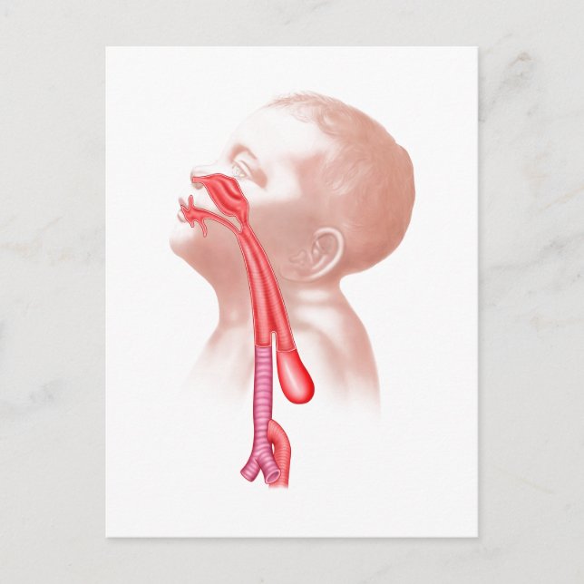 Anatomy Of A Tracheoesophageal Fistula Postcard (Front)