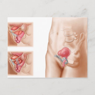 Anatomy Of Bladder Suspension Procedure Postcard