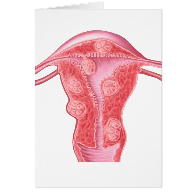 Anatomy Of Fibroid Tumours In Female Uterus (Front)