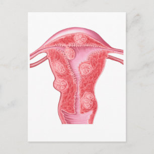 Anatomy Of Fibroid Tumours In Female Uterus Postcard