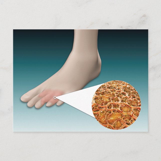 Anatomy Of Foot Fungus With Microscopic Close-Up Postcard (Front)