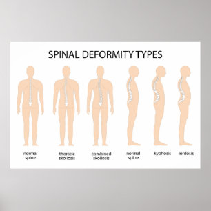 Anatomy of Spine deformity Poster