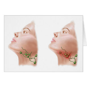 Anatomy Of Swollen Lymph Nodes