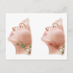 Anatomy Of Swollen Lymph Nodes Postcard