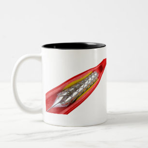 Angioplasty procedure Two-Tone coffee mug
