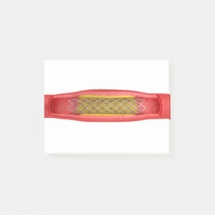 Angioplasty with stent placement post-it notes