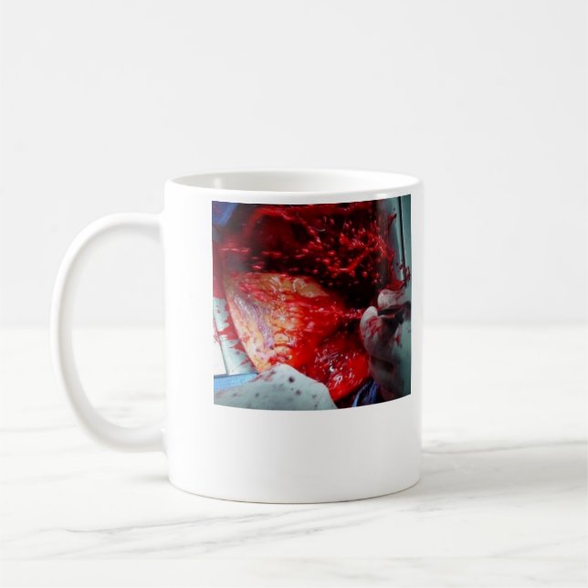 Ascending  Aortic  Dissection Coffee Mug (Left)
