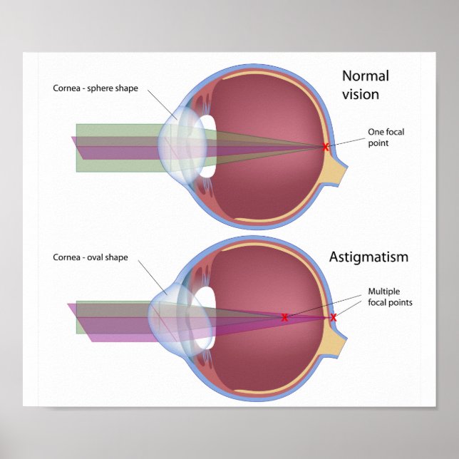 Astigmatism, a common eye defect Poster (Front)