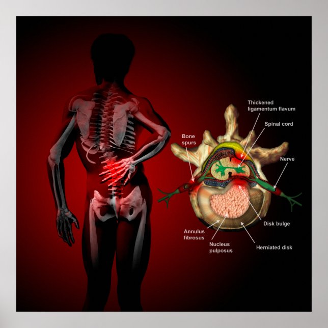 Back pain poster (Front)