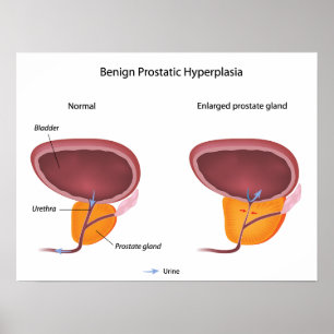 Benign prostatic hyperplasia  Poster