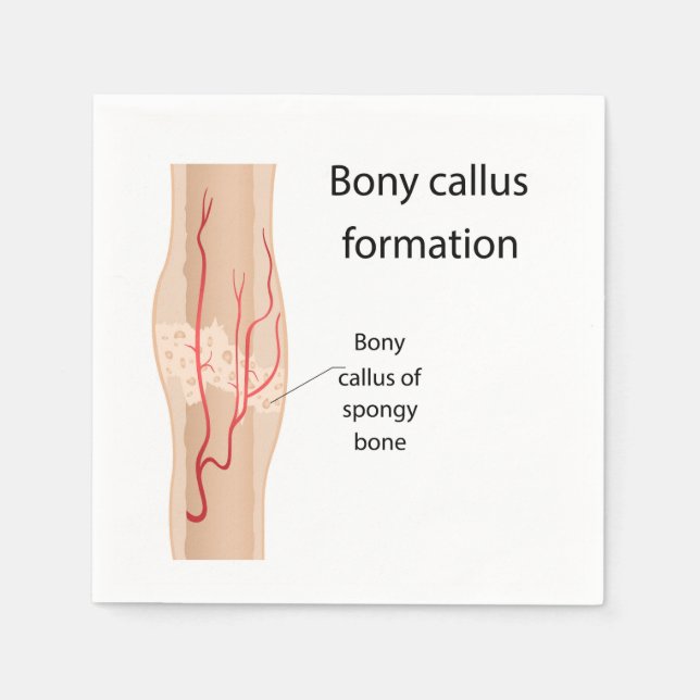 Bony callus formation  napkin (Front)