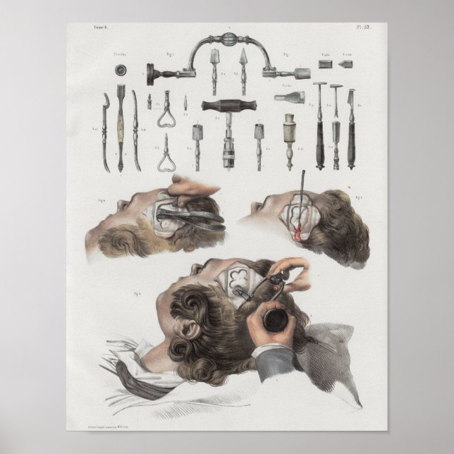 Brain Surgery Instruments Vintage Anatomy Print (Front)