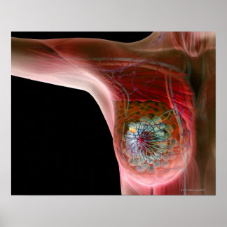 Breast cancer 2 poster