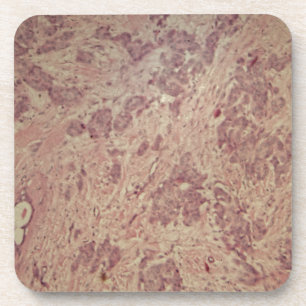 Breast cancer under the microscope coaster