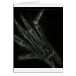 Broken Hand X-ray