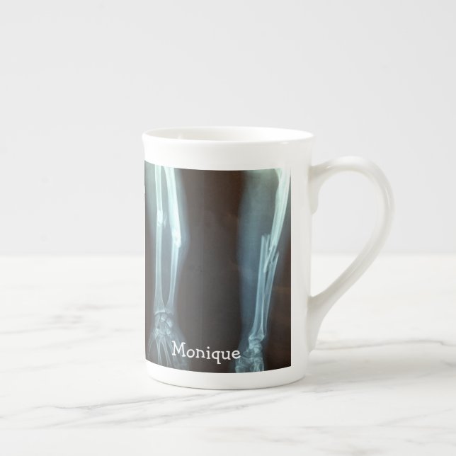 Broken Radius and Ulna Xray "Break Time"   Bone China Mug (Right)