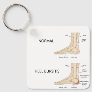 Calcaneal bursitis key ring