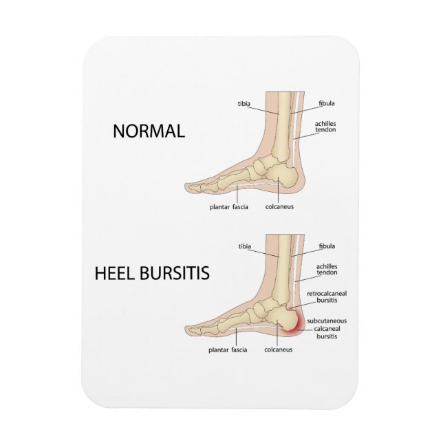 Calcaneal bursitis magnet (Vertical)