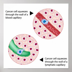 Cancer cell  metastasis Poster