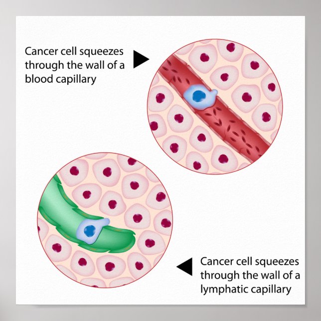Cancer cell  metastasis Poster (Front)