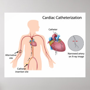Cardiac catheterisation Poster