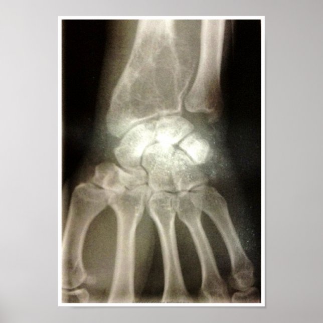 Carpals Xray Poster (Front)