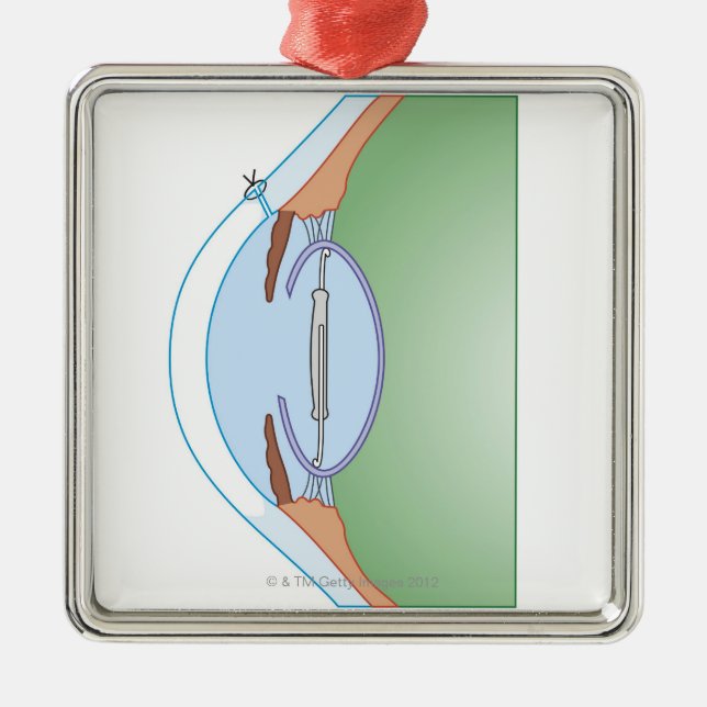 Cataract Surgery Metal Ornament (Front)