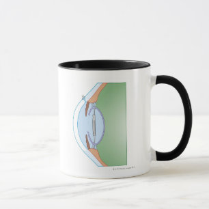 Cataract Surgery Mug