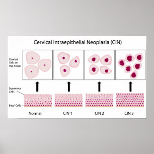 Cervical dysplasia stages and pap smear test poster