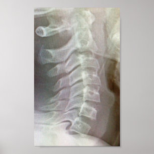 Cervical spine Tie Poster