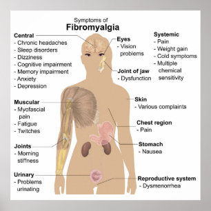 Chart Common Signs + Symptoms Fibromyalgia Poster