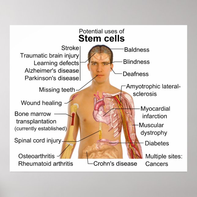 Chart of Potential Uses for Stem Cell Treatments (Front)